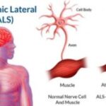 Cauzele emotionale ale Sclerozei laterale amiotrofice (SLA, ALS)